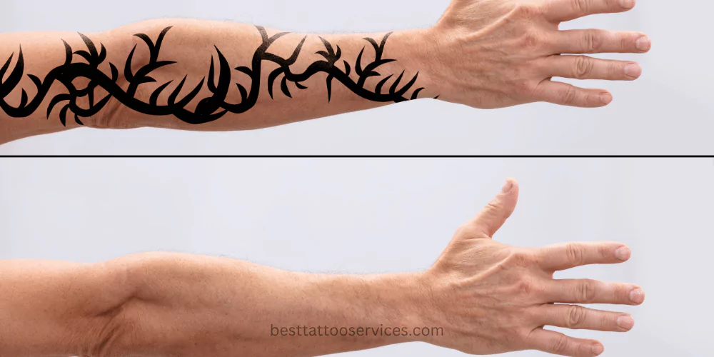 Tattoo Removal Options and Alternatives
