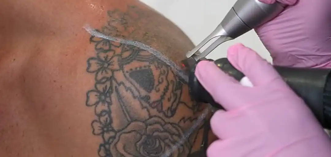 Full Sleeve Tattoo Removal