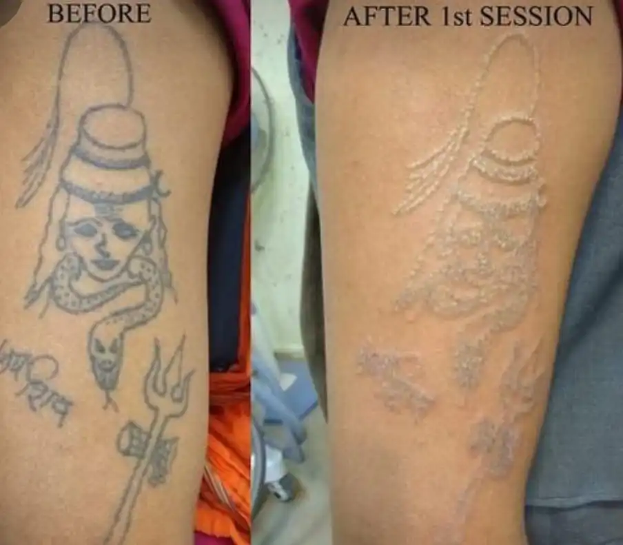 Reduce Swelling After Tattoo Removal